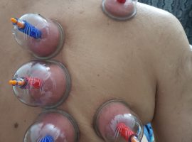 Cupping image-min